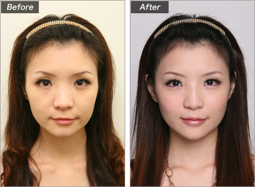 目の上のくぼみ(ヒアルロン酸注入) 症例写真1