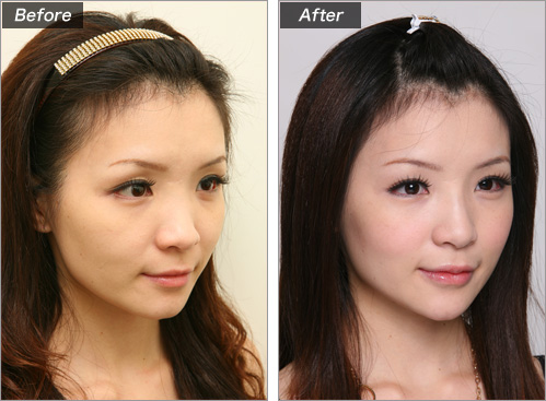 目の上のくぼみ(ヒアルロン酸注入) 症例写真2