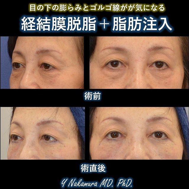 下まぶたのクマ取り(経結膜脱脂+脂肪注入)の症例写真