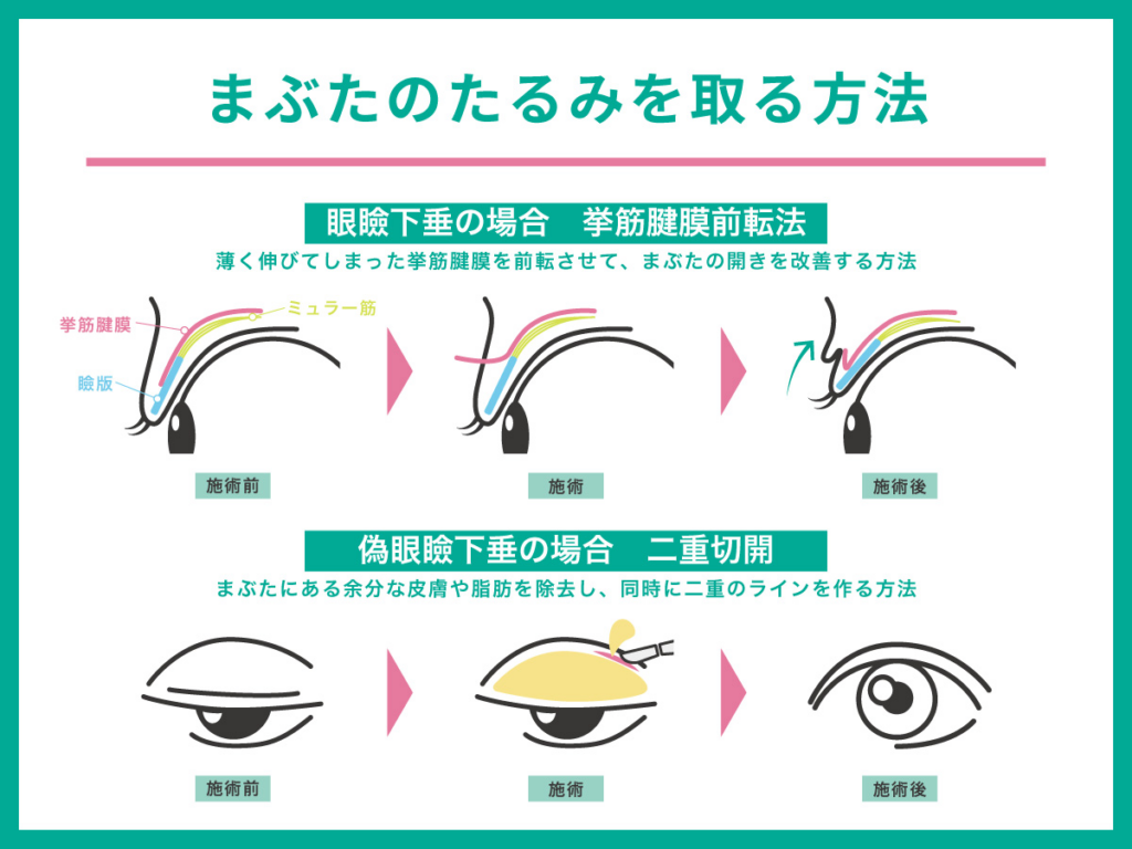 まぶたのたるみとは